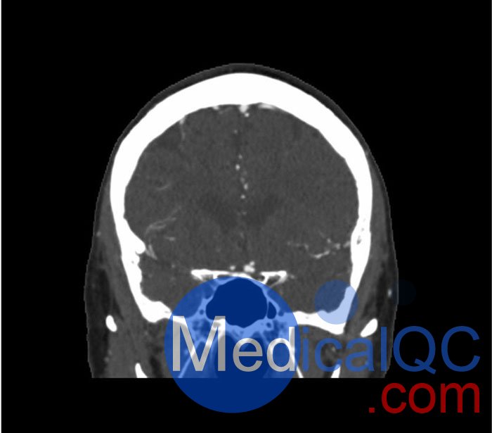 WEK50-03动脉瘤头模,WEK50-03血管造影CTA头模影像图