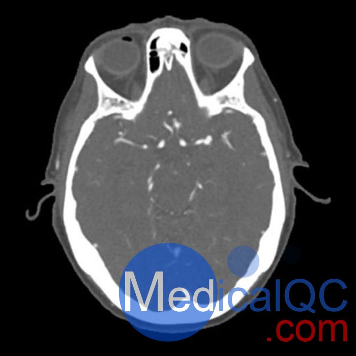WEK50-03动脉瘤头模,WEK50-03血管造影CTA头模影像图
