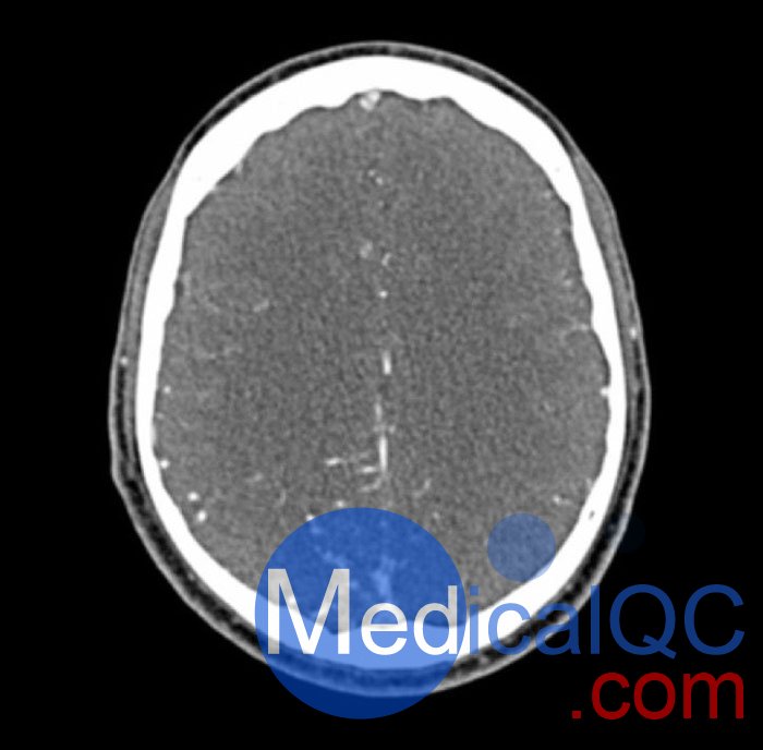 WEK50-04 CTA头模，带AVM CTA头模，WEK50-04 CT血管造影头模成像效果图