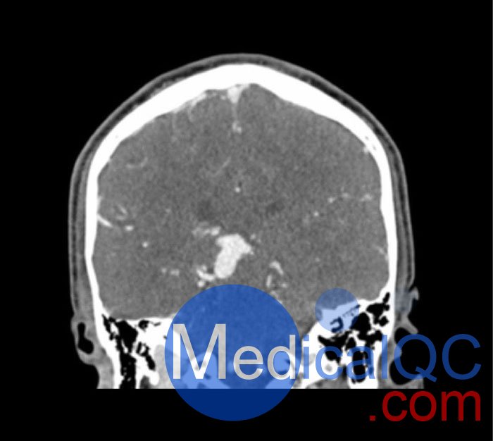 WEK50-04 CTA头模，带AVM CTA头模，WEK50-04 CT血管造影头模成像效果图