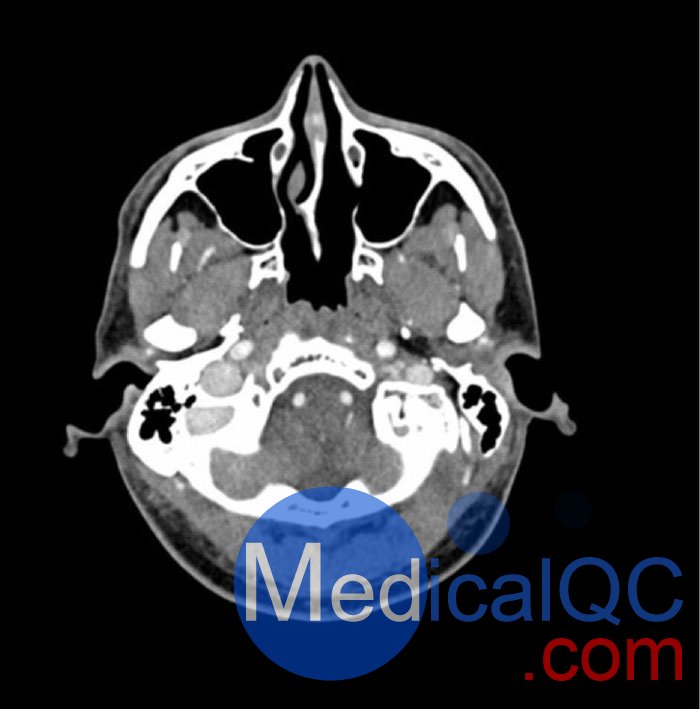 WEK-5005脑血管造影头模，WEK-5005头模， CTA AVM头模成像效果图