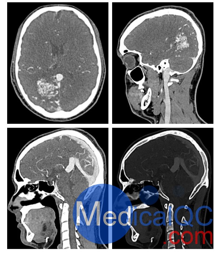WEK51-04 CTA AVM头部模体,WEK51-04 CT血管造影头模成像效果图