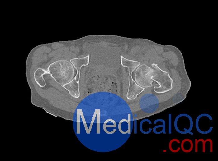 WEK54-01股骨颈骨折骨盆模型,WEK54-01骨盆模体成像效果图