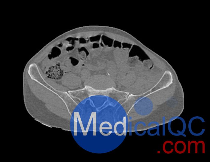 WEK54-01股骨颈骨折骨盆模型,WEK54-01骨盆模体成像效果图